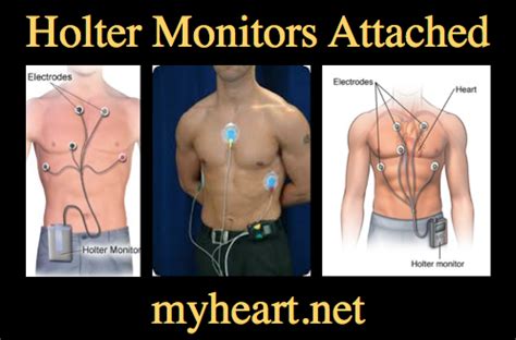 Holter Monitor Explained by a Cardiologist • MyHeart.